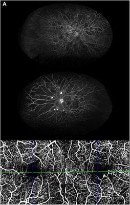 Peripheral and central capillary non-perfusion in diabetic retinopathy: An updated overview